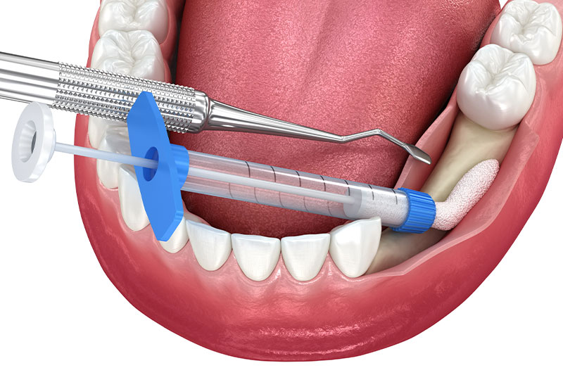 Bone Grafting in Alamosa