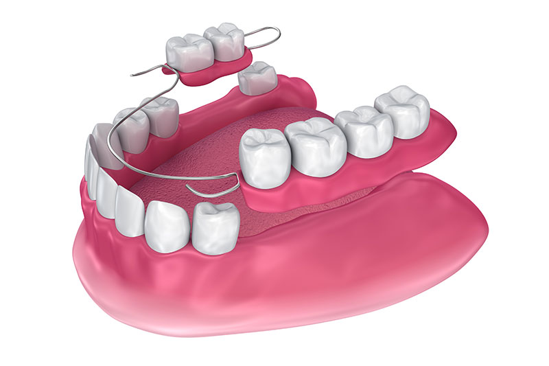 Partial Dentures in Alamosa