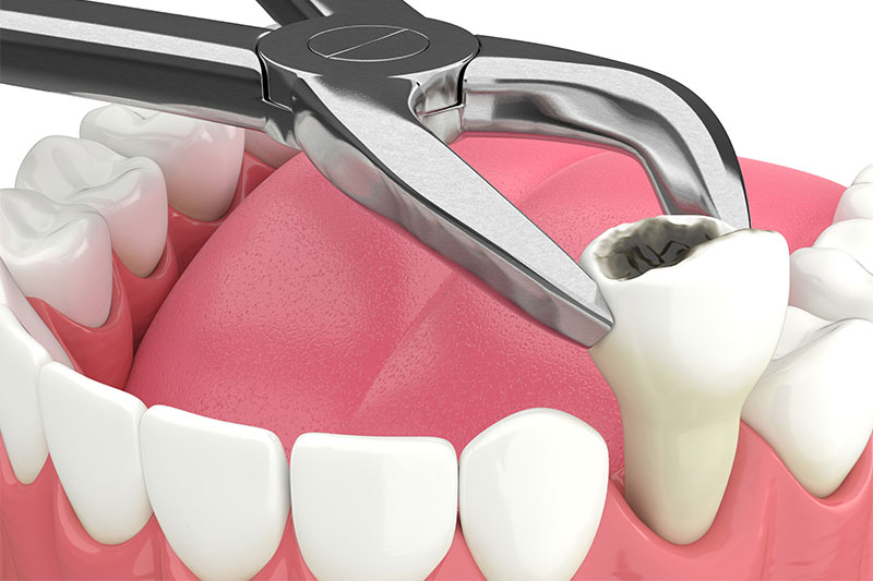Wisdom Teeth Extraction Alamosa